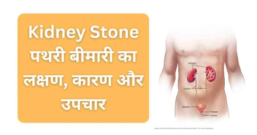 Kidney Stone पथरी बीमारी का लक्षण, कारण और उपचार
